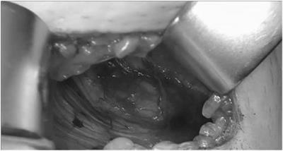 Comparison and Standardisation of Various Open Preperitoneal Techniques in Inguinal Hernia Surgery–Results of a Review and Consensus